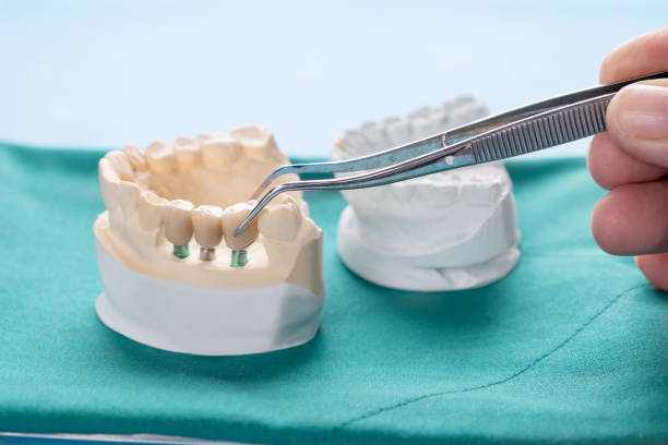 Dental implant and bridge model comparison