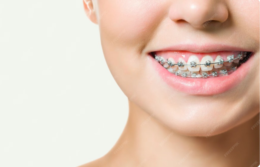 Traditional braces treatment at Dentaura