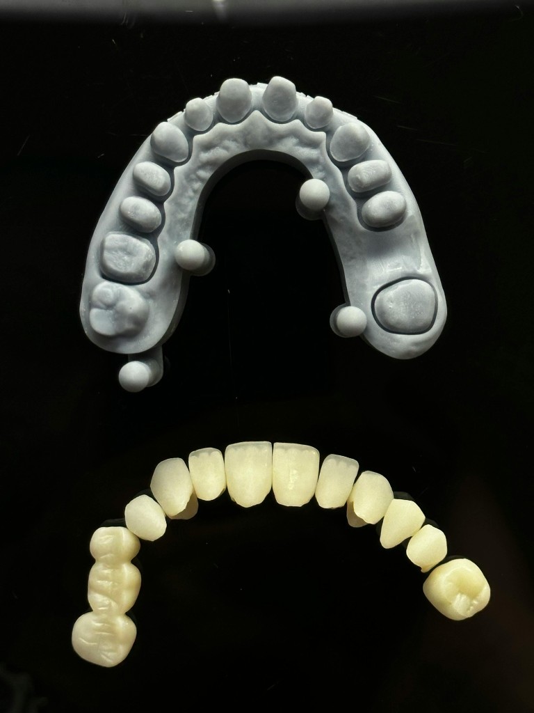 Caps and bridges dental restoration model