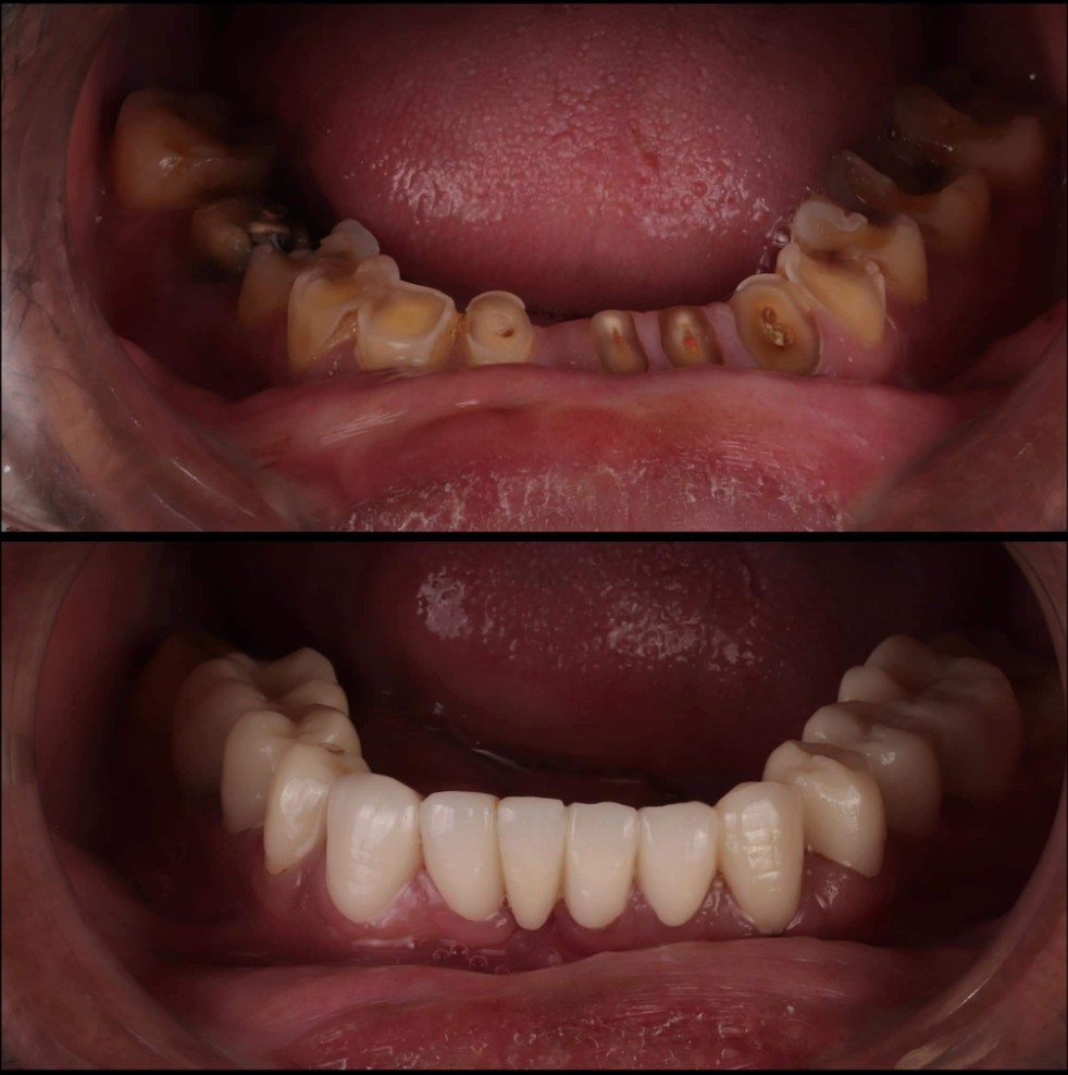 Before and after lower arch full mouth rehabilitation with veneers, implants, crowns, and bridges