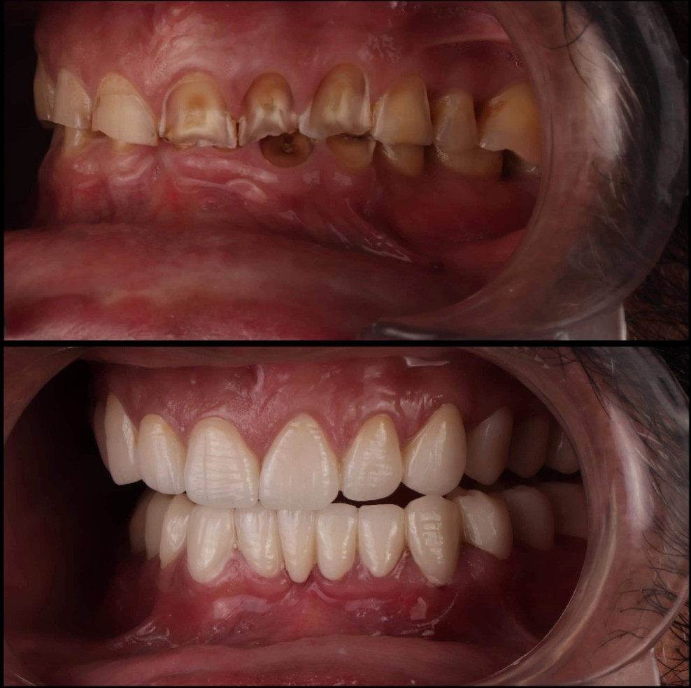 Before and after side view full mouth rehabilitation showing worn teeth restored to a natural smile