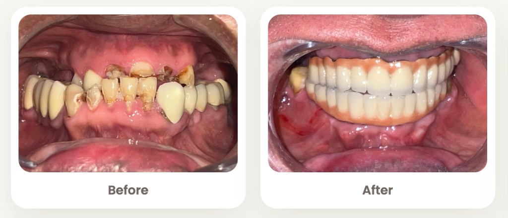Before and after full mouth rehabilitation with implant-supported fixed prosthesis