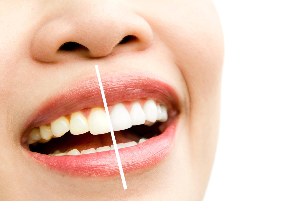Teeth whitening before and after shade comparison