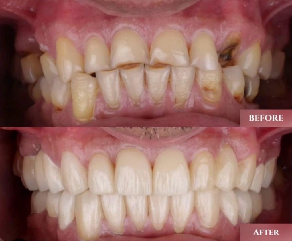 Veneers before and after smile correction at Dentaura